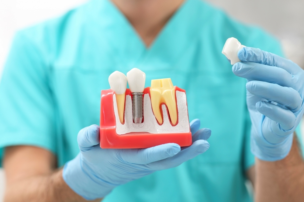 Dental implants 101