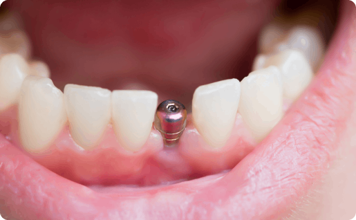 Dental implant