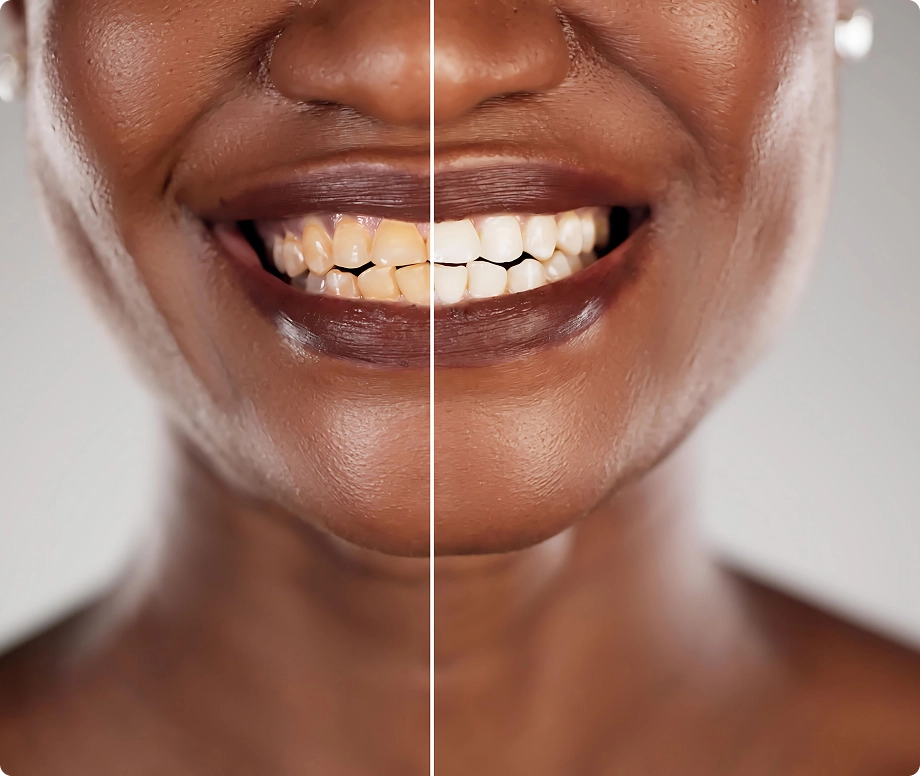 Woman dental picture before after
