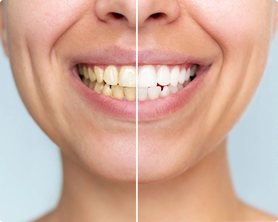 Woman picture before after smile